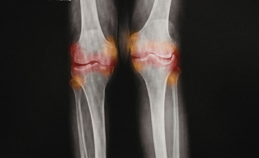 La Gonartrosis: Grados y Tratamientos para Combatirla