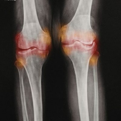 La Gonartrosis: Grados y Tratamientos para Combatirla