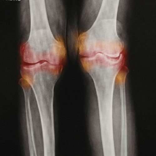 La Gonartrosis: Grados y Tratamientos para Combatirla