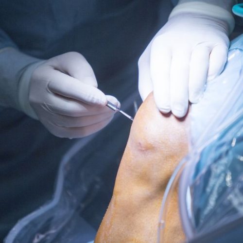 La Artroscopia de Rodilla: Una Revolución en la Cirugía Ortopédica